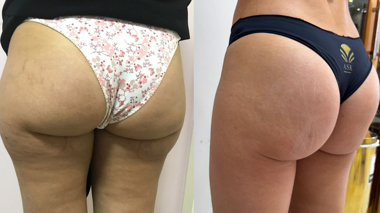 Procedimento de Bumbum