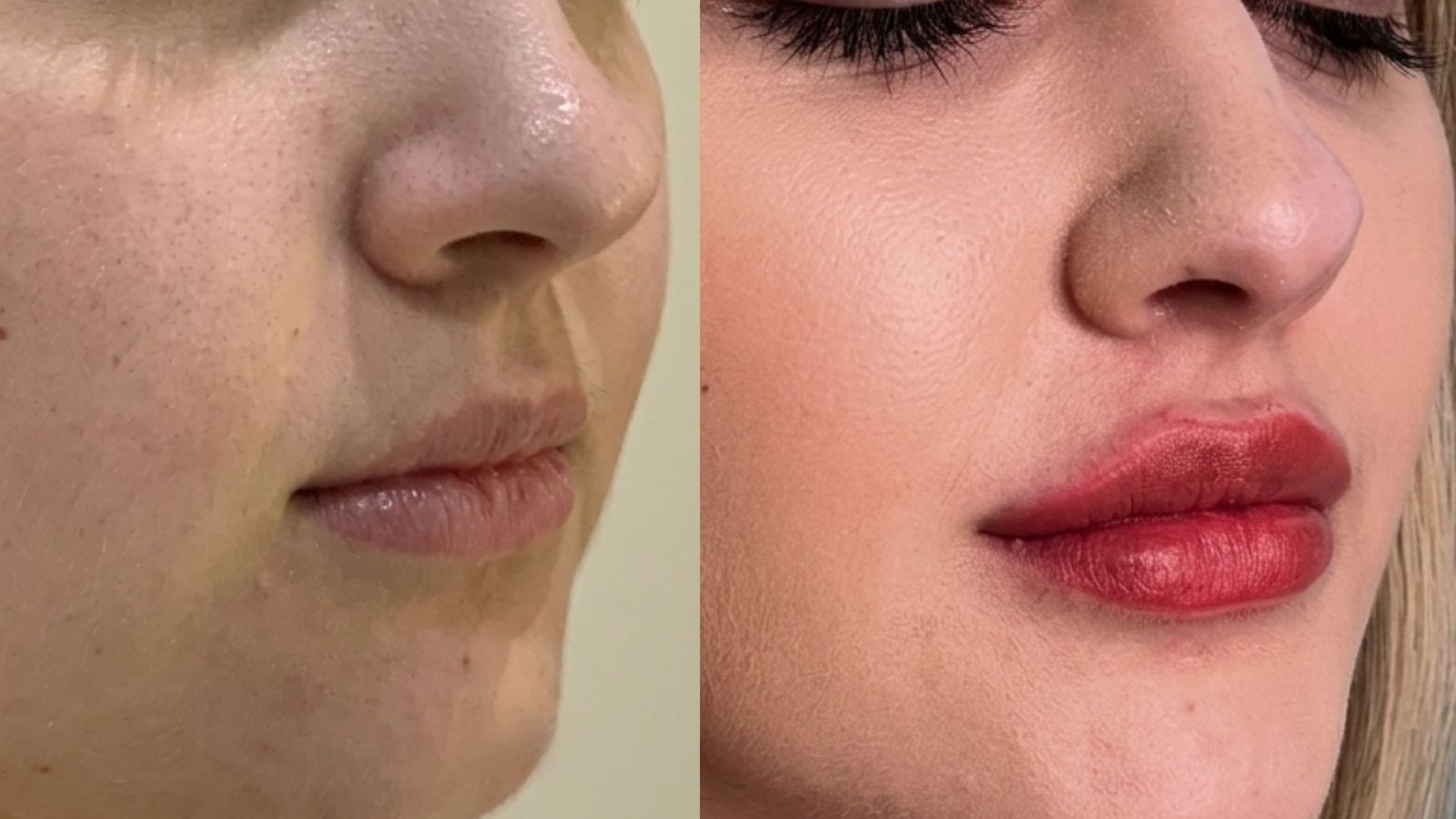 Procedimento de Preenchimento Labial